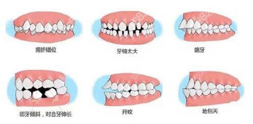 广州牙齿矫正比较厉害的医生推荐