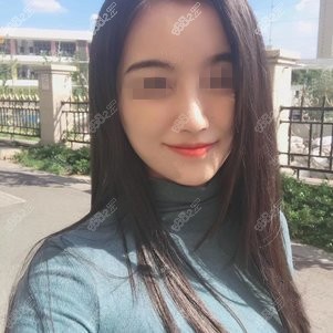 找上海伯思立<!--<i data=20240705-sp></i>-->做鼻综合术后50天