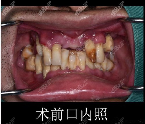 慈溪种植牙医生