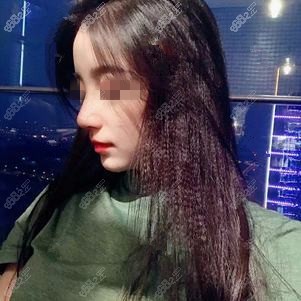 找上海伯思立<!--<i data=20240705-sp></i>-->做鼻综合术后70天