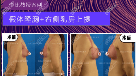 北医三院整形科李比假体隆胸+右侧乳房上提案例