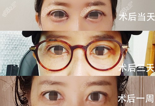 双眼皮术后恢复