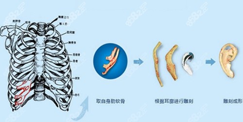 广州高尚余文林肋骨再造耳手术过程