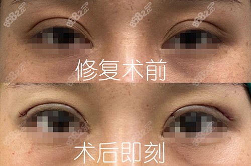杭州张霞飞医生双眼皮修复