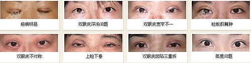 白永辉双眼皮修复怎么样?北京韩啸这里有口碑、案例和价格