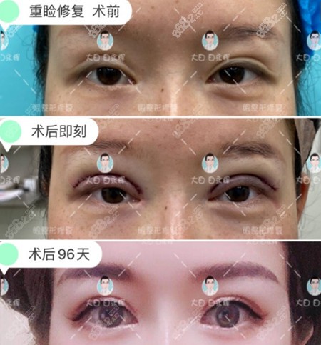 <!--<i data=20240705-sp></i>-->白永辉双眼皮修复案例