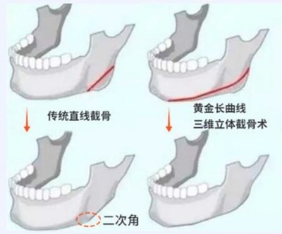 何照华医生三维立体截骨术