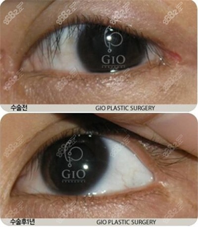 韩国GIO整形医院眼角修复案例