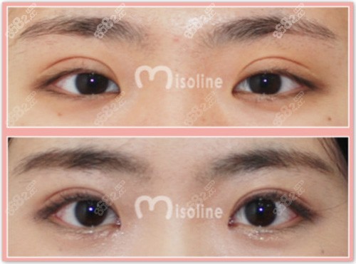 韩国Misoline整形外科双眼皮修复案例