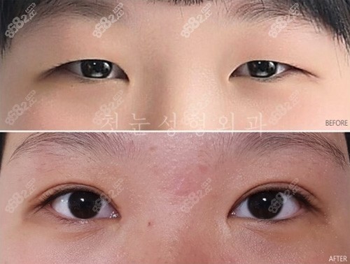 韩国初雪整形外科双眼皮案例