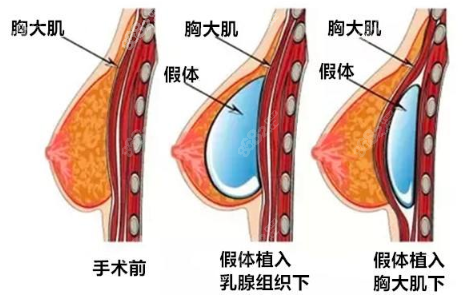 假体丰胸手术图解