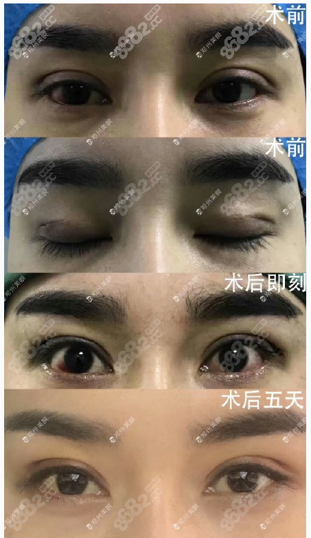 全切双眼皮半个月大小眼明显做修复手术案例