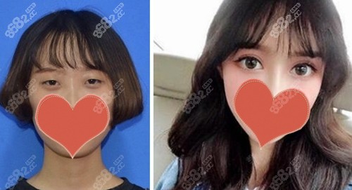 三亚红妆尚薛开兴双眼皮案例