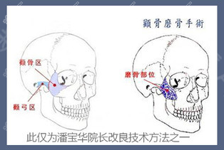 颧骨降低图解