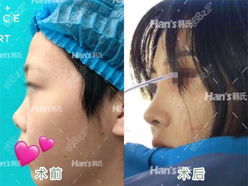 济南韩氏整形外科医院隆鼻<span style=