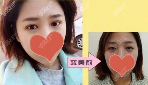<!--<i data=20240705-sp></i>-->周敏茹双眼皮案例