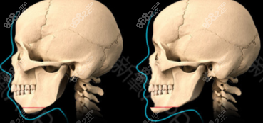 下巴截骨三维移动手术