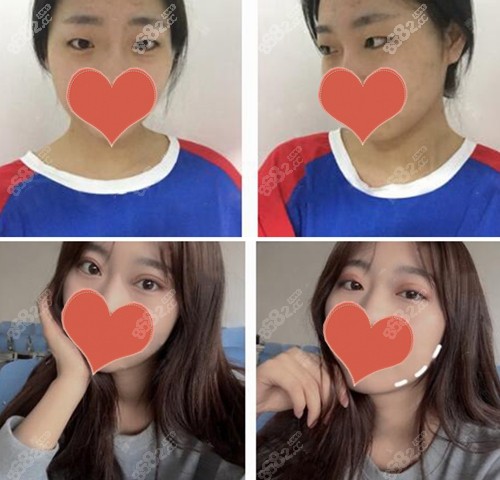 三亚维多利亚李善双眼皮案例