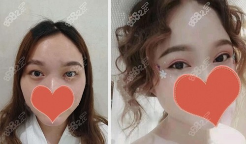 三亚华美张少林双眼皮案例