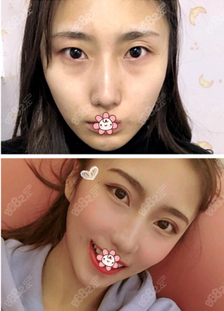 上海美联臣陈红梅眼综合案例