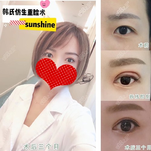 姜辉双眼皮案例