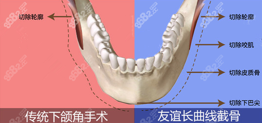 成都友谊下颌角截骨术的优势