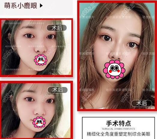 哈尔滨斯美诺张宁割双眼皮怎么样？