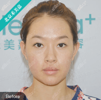 找北京脂肪填充好的禾美嘉韦辉做脂肪填充全脸没啥后遗症