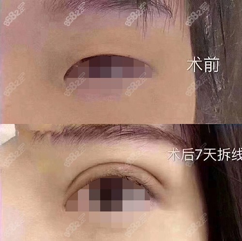 台州艺星双眼皮术前术后对比