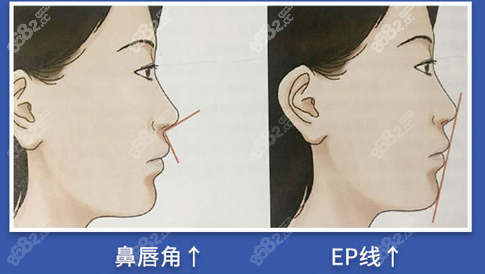 鼻唇角和EP线