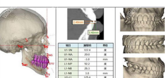 <!--<i data=20240705-sp></i>-->医生的Le Fort I型截骨手术法