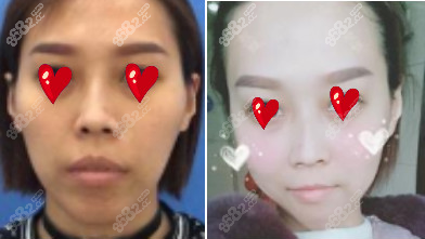 <!--<i data=20240705-sp></i>-->医生做正颌手术的真人案例