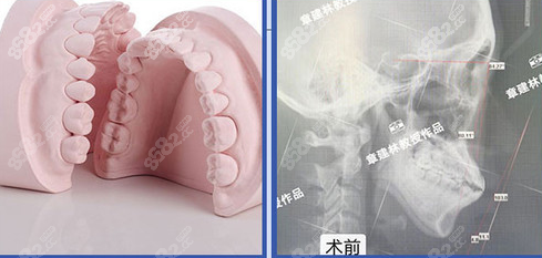 <!--<i data=20240705-sp></i>-->医生先做正颌后做矫正示意图