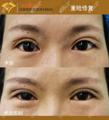 沈阳杏林张莹莹双眼皮失败修复真人前后对比照