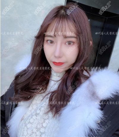 术后25天恢复的还不错,鼻小柱的伤口也已经结痂了