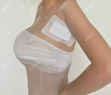 做完假体隆胸后胸部被纱布包裹住的样子 做完假体隆胸后胸部被纱布包裹住的样子