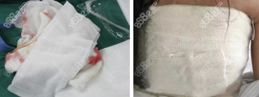 假体隆胸所用的纱布 假体隆胸所用的纱布