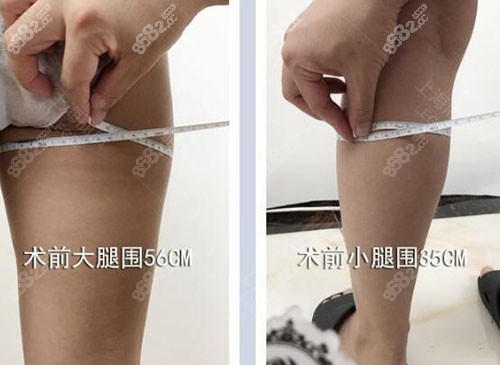 分享我找上海丽质卢九宁做大腿吸脂,4万做直腿成型效果不错