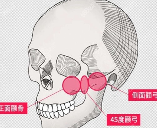 颧骨颧弓降低手术原理