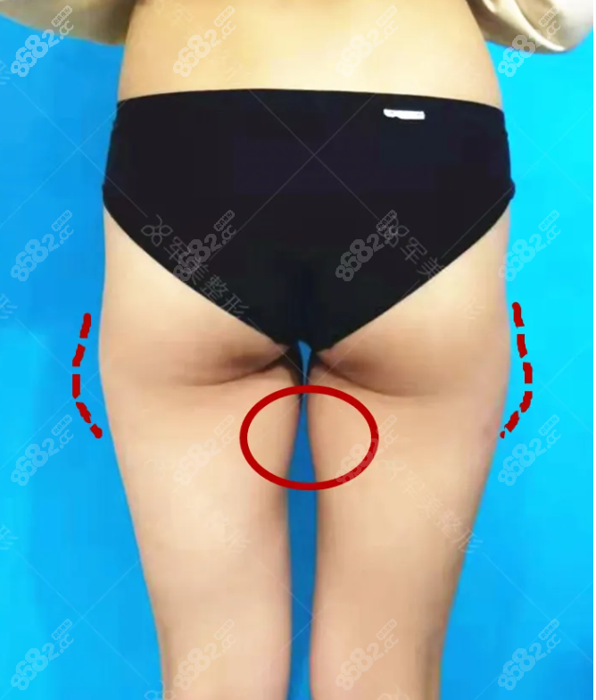 大腿吸脂术前面诊王世虎医生