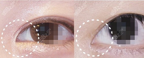 眼角過寬修復(fù)后對(duì)比