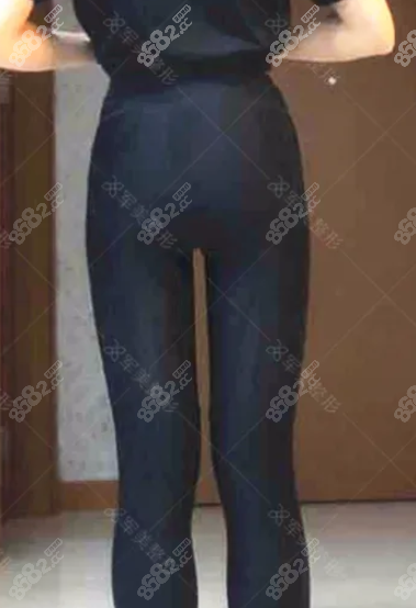 术后两个月大腿吸脂效果