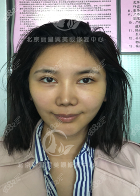 北京丽星翼美魏志香给我做双眼皮修复1个月