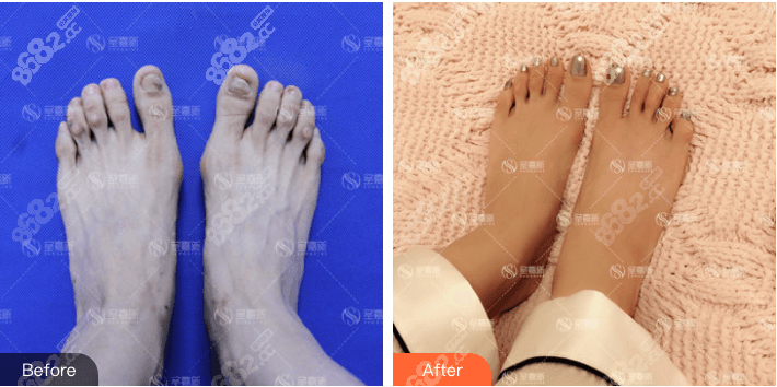 苏敬达大脚骨技术实力怎么样?微孔去大脚骨手术<span style= 苏敬达大脚骨技术实力怎么样?微孔去大脚骨手术<span style=