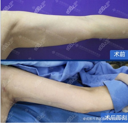 宋华敬医生的吸脂案例