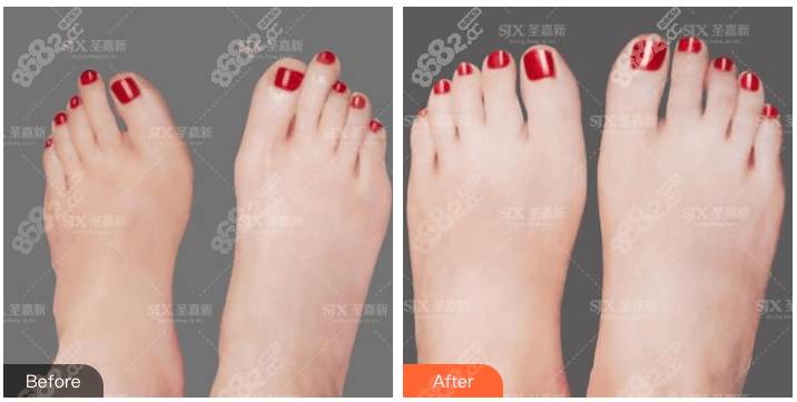 北京圣嘉新大脚骨手术好不好?苏敬达微孔去大脚骨<span style= 北京圣嘉新大脚骨手术好不好?苏敬达微孔去大脚骨<span style=