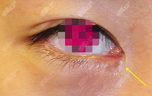 開眼角淚阜暴露過多