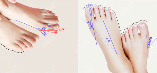 北京圣嘉新大脚骨手术依据的美足标准示意图 北京圣嘉新大脚骨手术依据的美足标准示意图