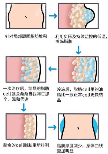 冷冻溶脂的原理