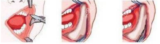 下頜角手術(shù)時候的完全口內(nèi)切口